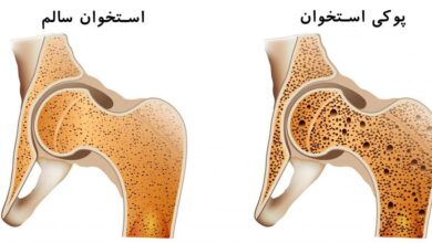 تصویر ۲۴.۵ درصد زنان تبریزی دچار پوکی استخوان هستند